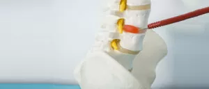 herniated-disc
