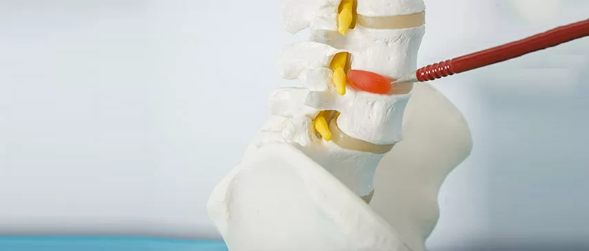 herniated-disc