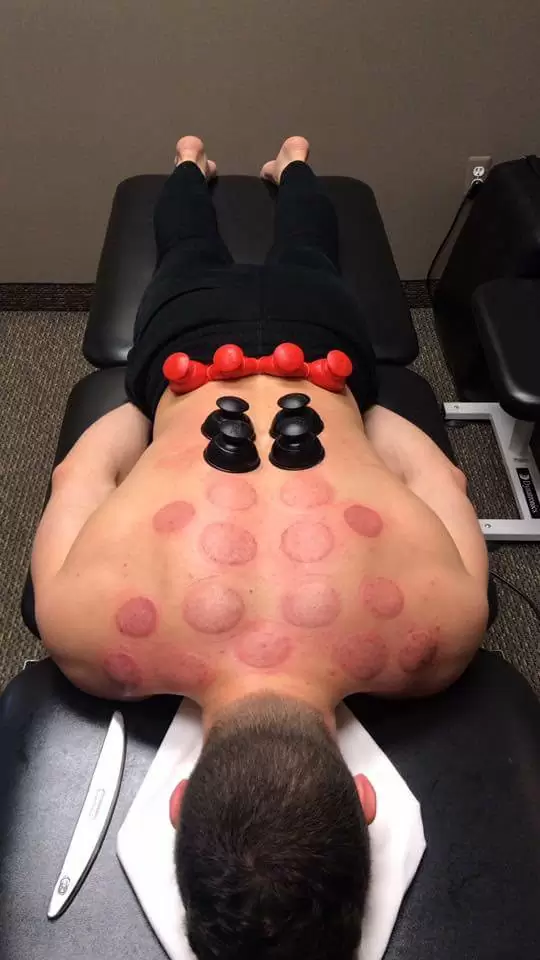 Cupping Therapy