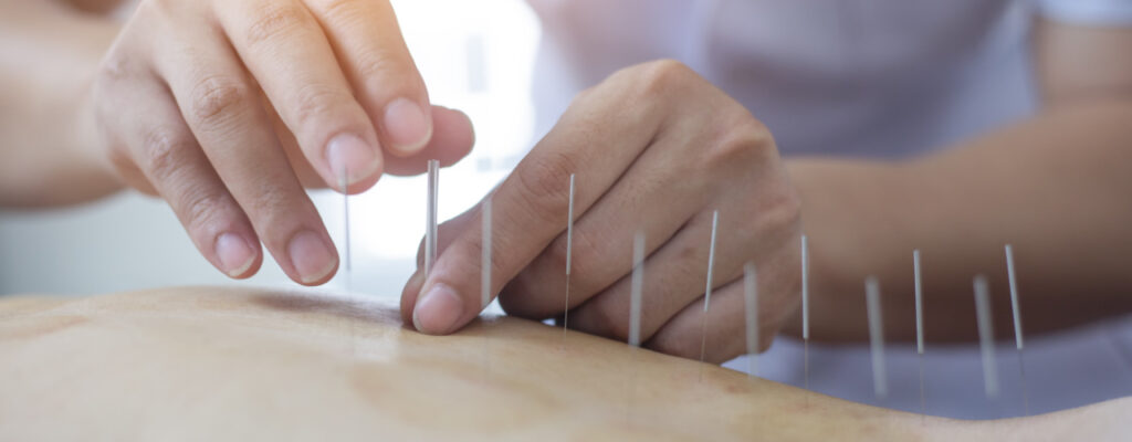 Dry Needling Michigan