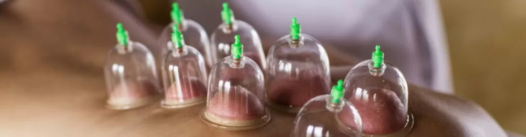 cupping Michigan
